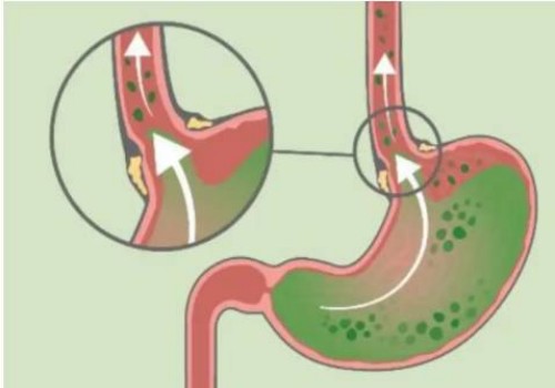 寧波供卵試管：做試管需要對精子怎么處理，需要預洗嗎